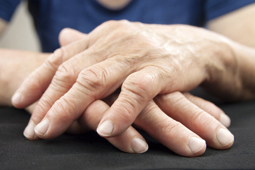 Can Pilates help rheumatoid arthritis? - Older ladies hands