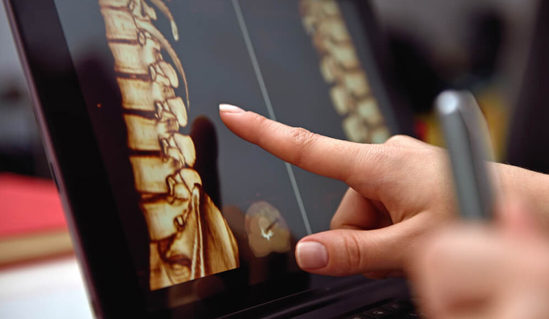 Your questions answered about spine injections