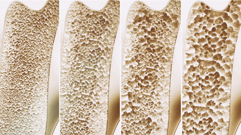 Why is reduced Bone Mineral Density a problem