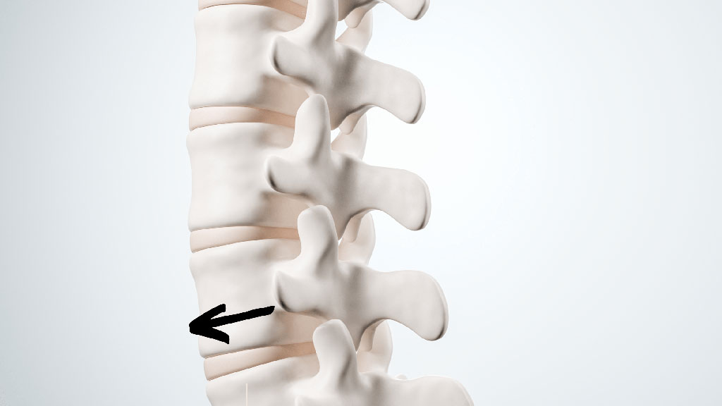 hoto of spine showing direction of spondylolisthesis