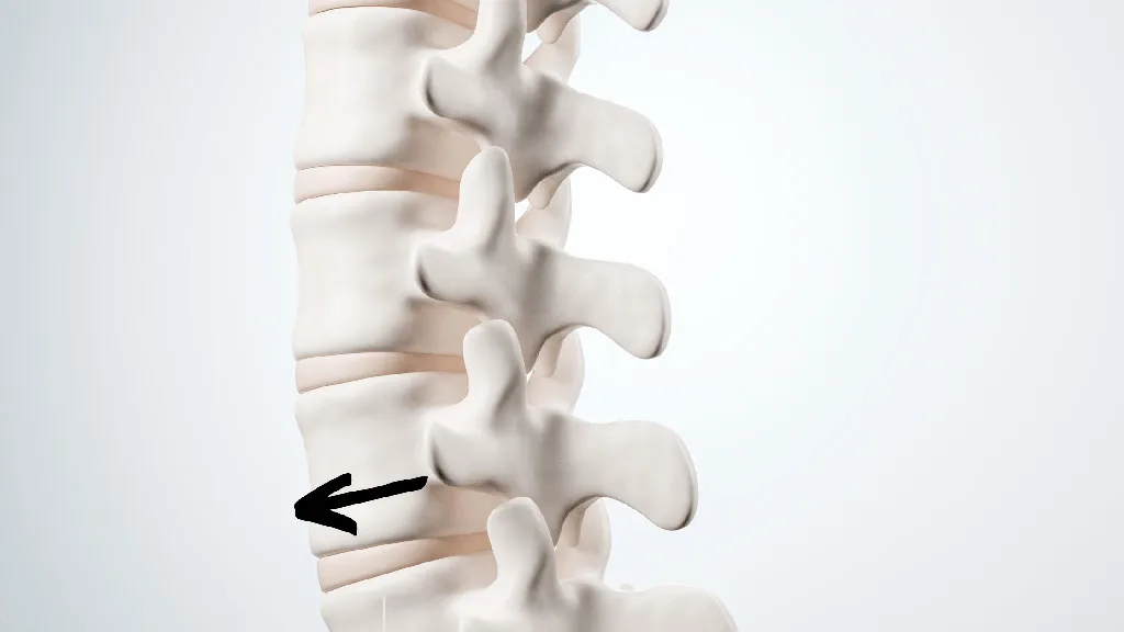 hoto of spine showing direction of spondylolisthesis