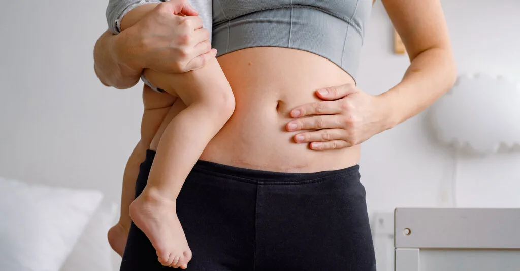 When Can You Start To Exercise After A C-Section